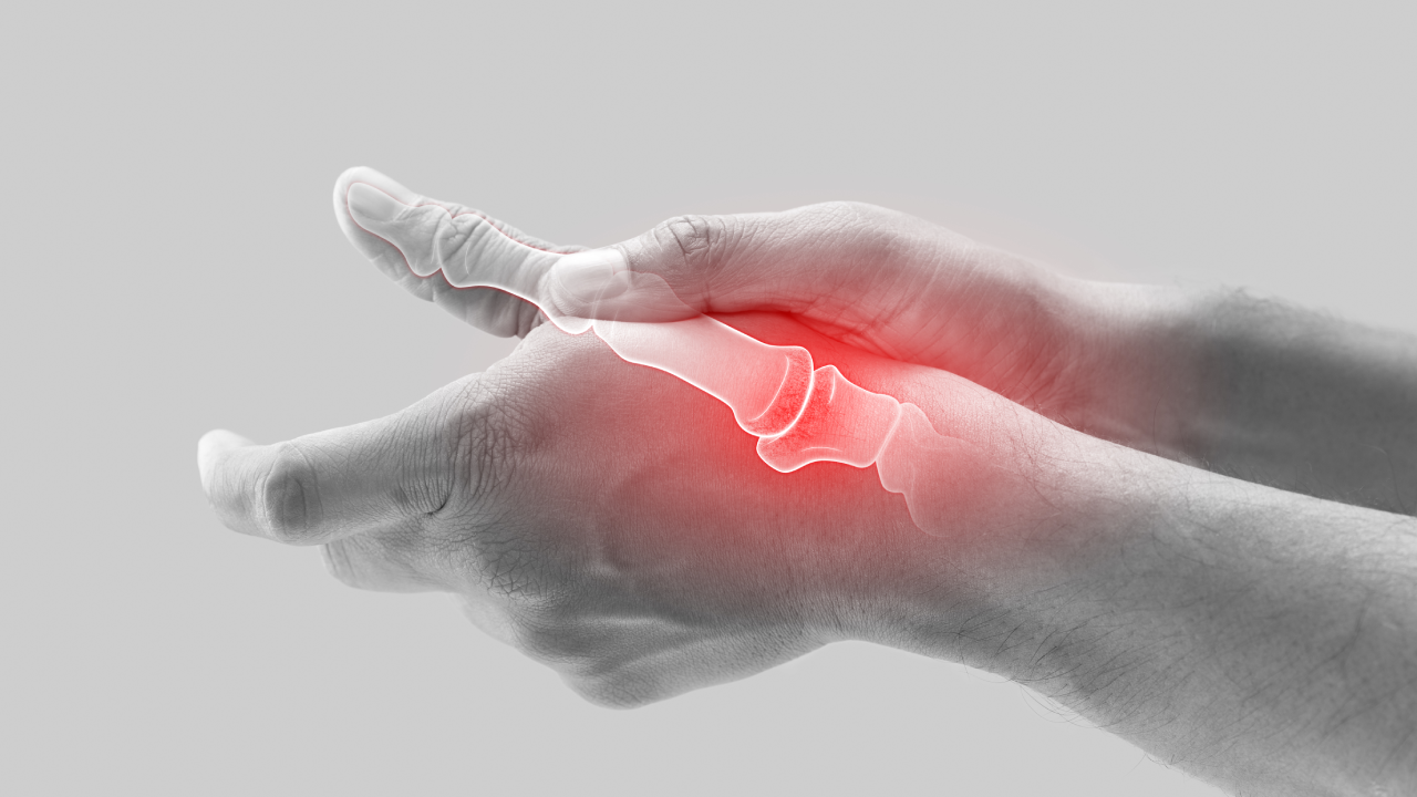 Arthritis