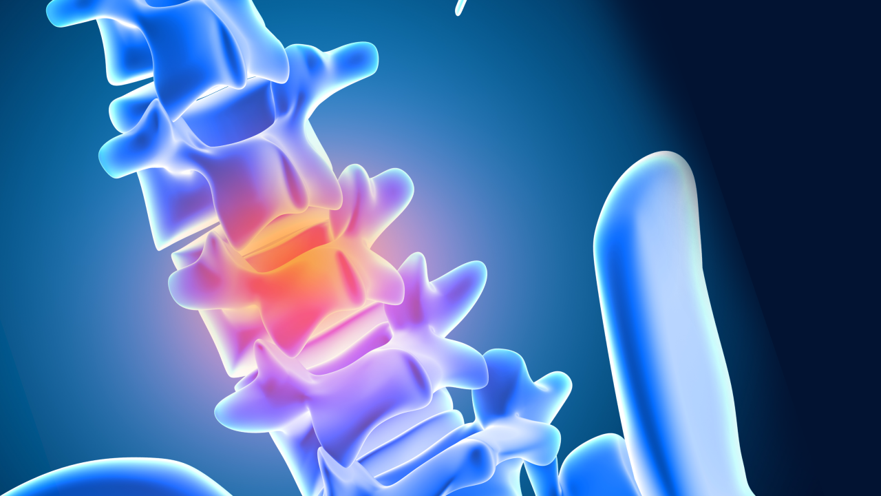 Disc Prolapse