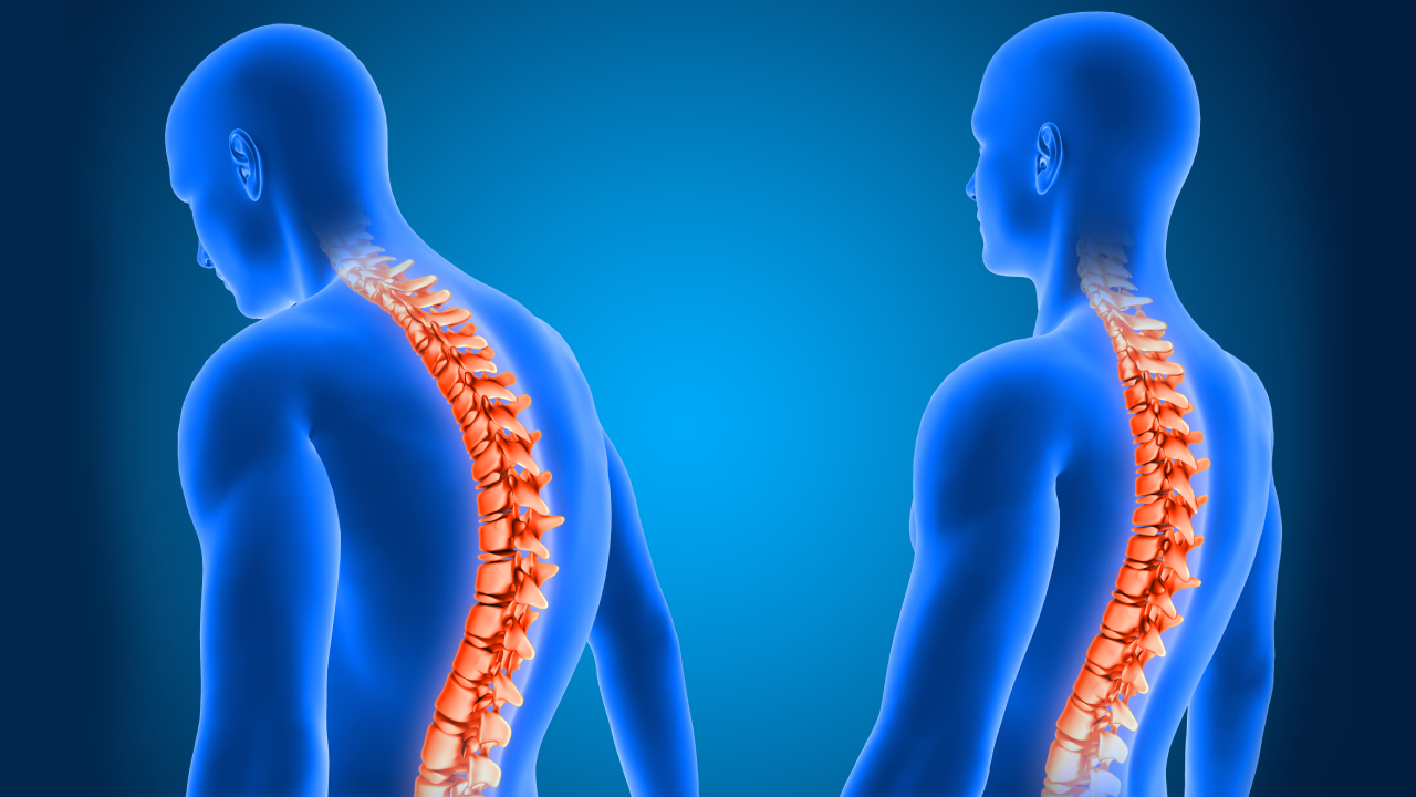 Scoliosis